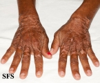 pellagra