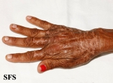 pellagra