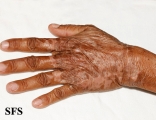 pellagra