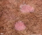 psoriasis_and_vitiligo