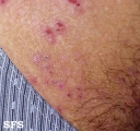 dermatitis herpetiformis