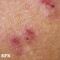 dermatitis herpetiformis