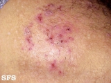 dermatitis herpetiformis