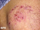 dermatitis herpetiformis