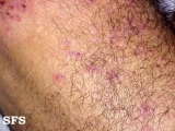 dermatitis herpetiformis
