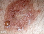 dermatitis herpetiformis