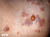 dermatitis herpetiformis