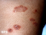 dermatitis herpetiformis