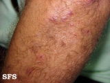 dermatitis herpetiformis