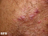 dermatitis herpetiformis
