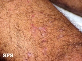 dermatitis herpetiformis