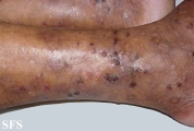 dermatitis herpetiformis