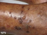 dermatitis herpetiformis