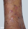 dermatitis herpetiformis