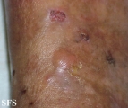 dermatitis herpetiformis