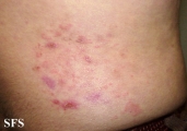 dermatitis herpetiformis