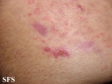 dermatitis herpetiformis