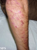 dermatitis herpetiformis