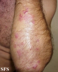 dermatitis herpetiformis