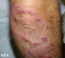 dermatitis herpetiformis
