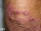 dermatitis herpetiformis
