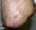 dermatitis herpetiformis