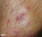 dermatitis herpetiformis