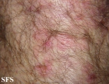 dermatitis herpetiformis