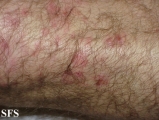 dermatitis herpetiformis