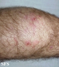 dermatitis herpetiformis