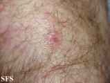dermatitis herpetiformis