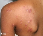 dermatitis herpetiformis
