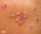 dermatitis herpetiformis