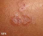 dermatitis herpetiformis