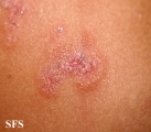 dermatitis herpetiformis