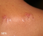 dermatitis herpetiformis