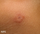 dermatitis herpetiformis