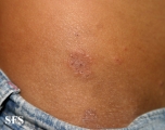 dermatitis herpetiformis