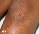 dermatitis herpetiformis