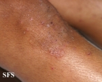 dermatitis herpetiformis