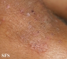 dermatitis herpetiformis