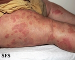 dermatitis herpetiformis