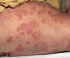 dermatitis herpetiformis