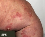 dermatitis herpetiformis