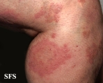 dermatitis herpetiformis
