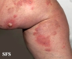 dermatitis herpetiformis