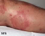dermatitis herpetiformis