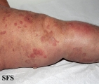 dermatitis herpetiformis