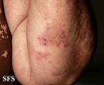 dermatitis herpetiformis