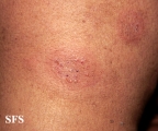 dermatitis herpetiformis
